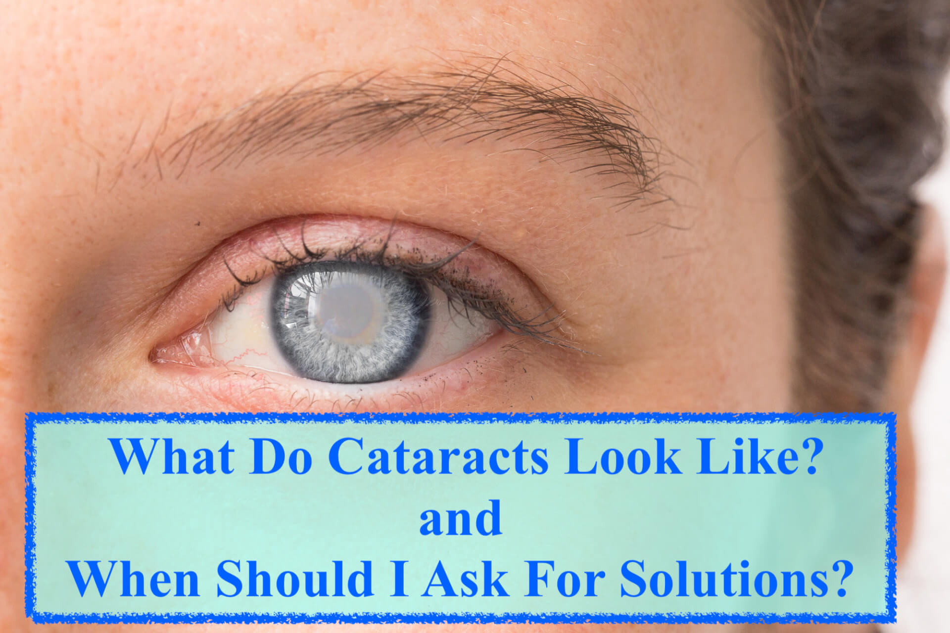 What Do Cataracts Look Like, and When Should I Ask For Solutions?