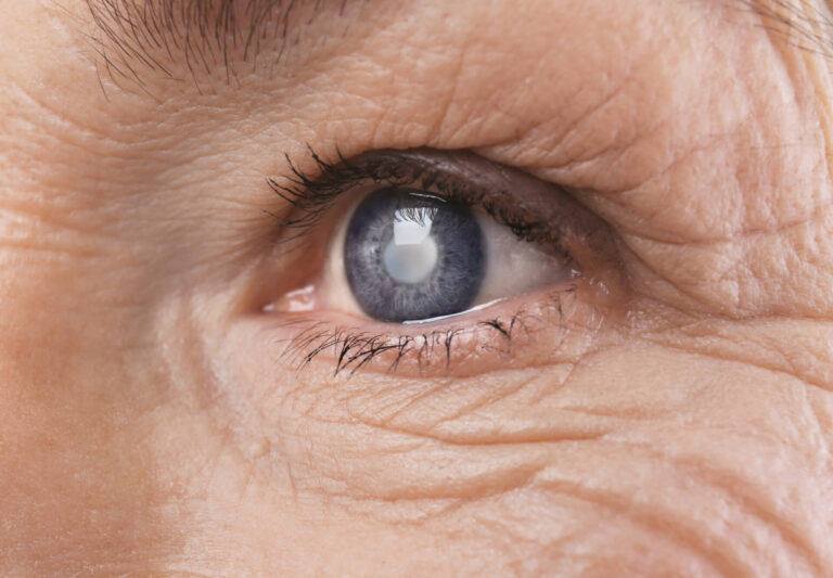 cataract surgery
