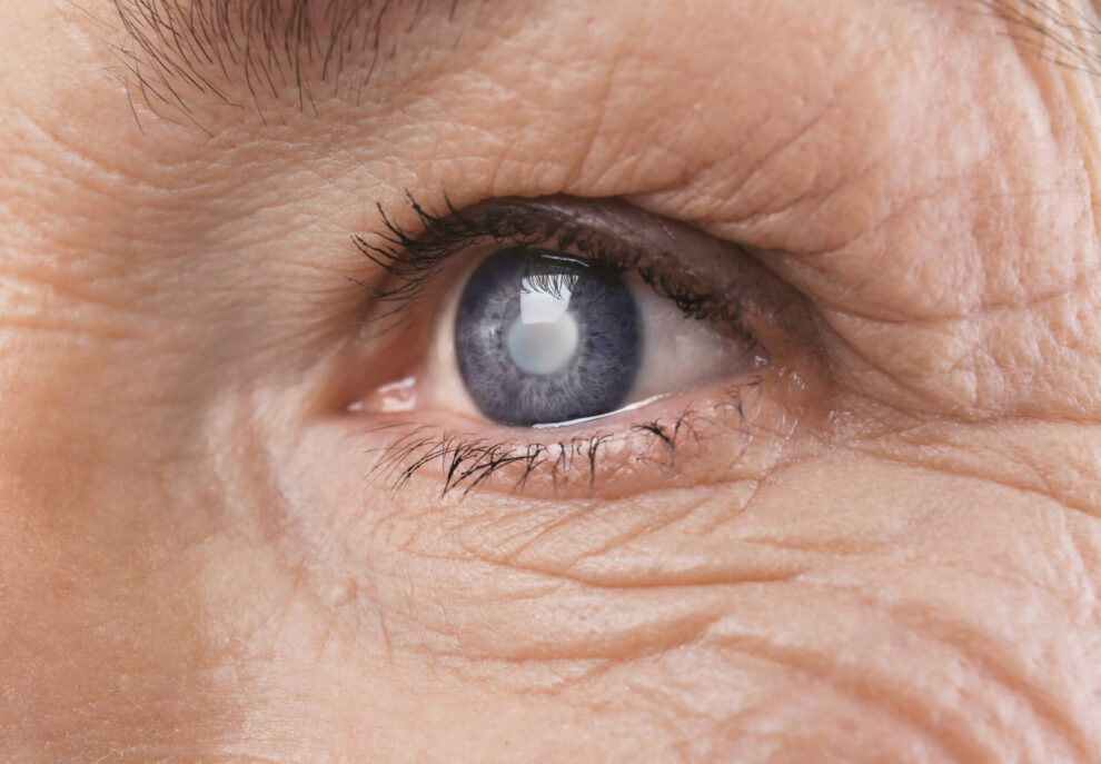 cataract surgery