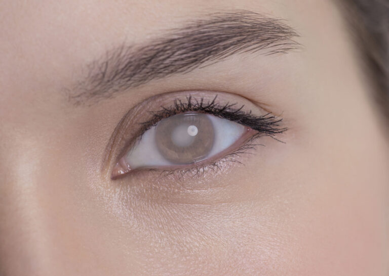signs of cataracts